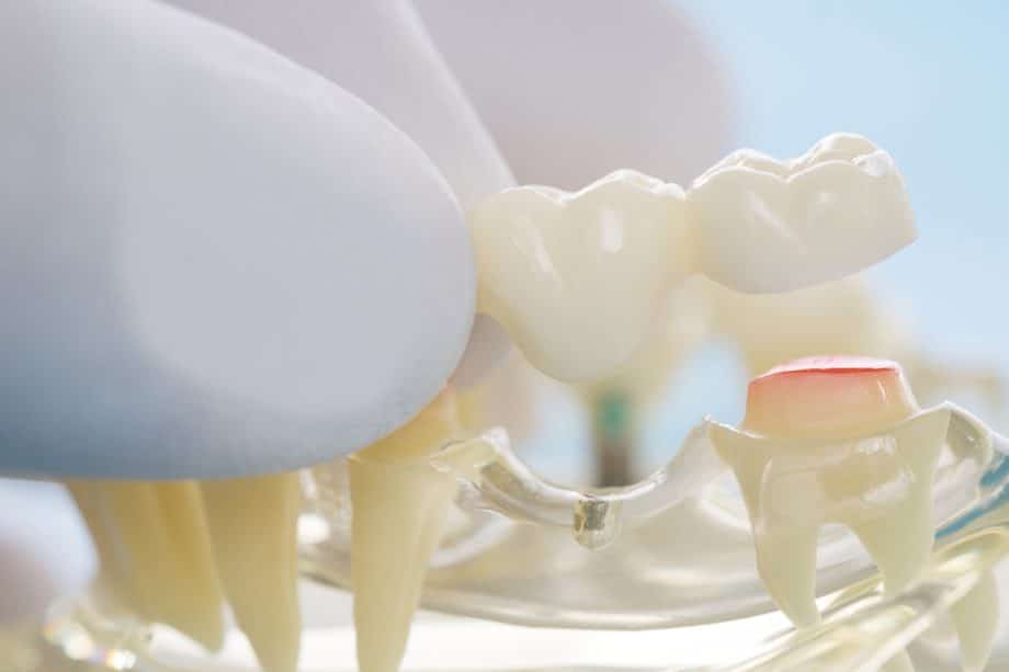 How Long Do Dental Bridges Last?