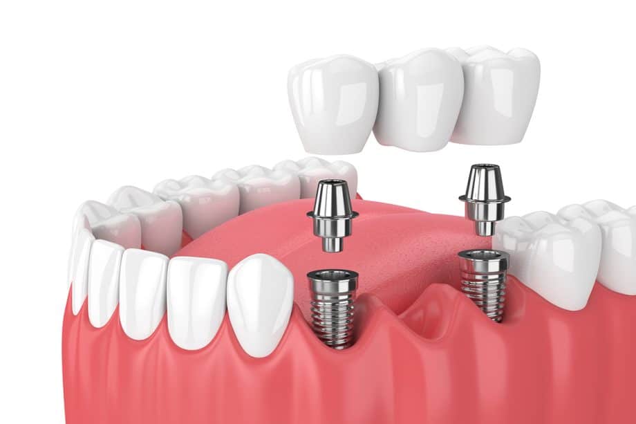 How Long Does It Take To Get Used To A Dental Bridge?