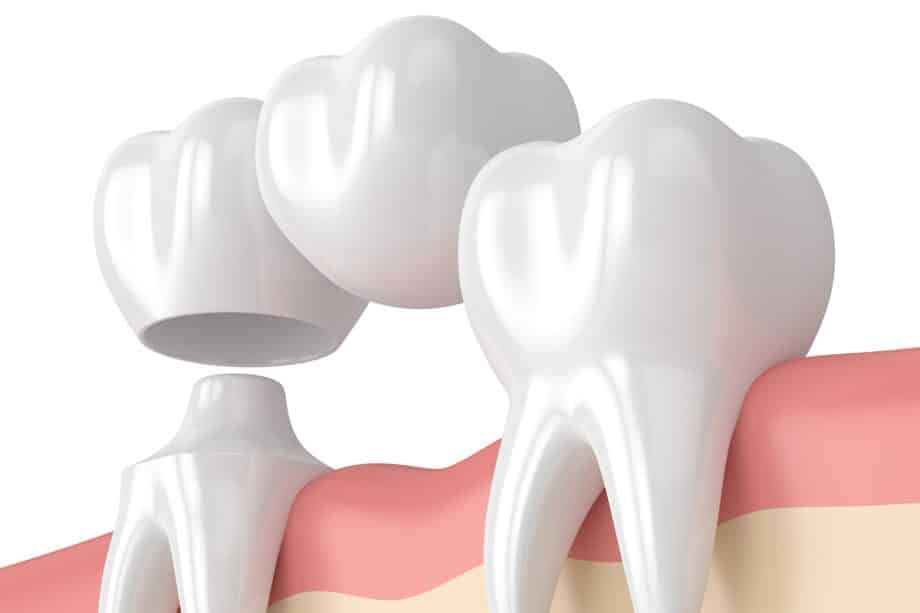 How Much Does A Dental Bridge Cost in Snellville, GA?