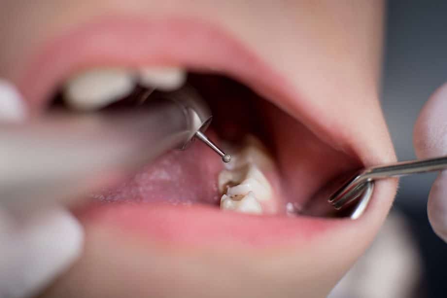 Understanding Tooth Sensitivity After Fillings: What You Need to Know