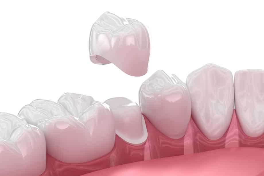 What Are Dental Crowns?