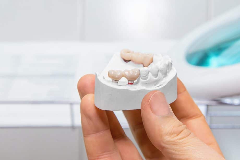 What Is A Dental Bridge?