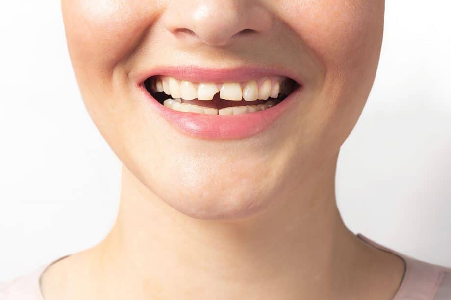 What to Do If You Break a Tooth on the Weekend in Snellville, GA