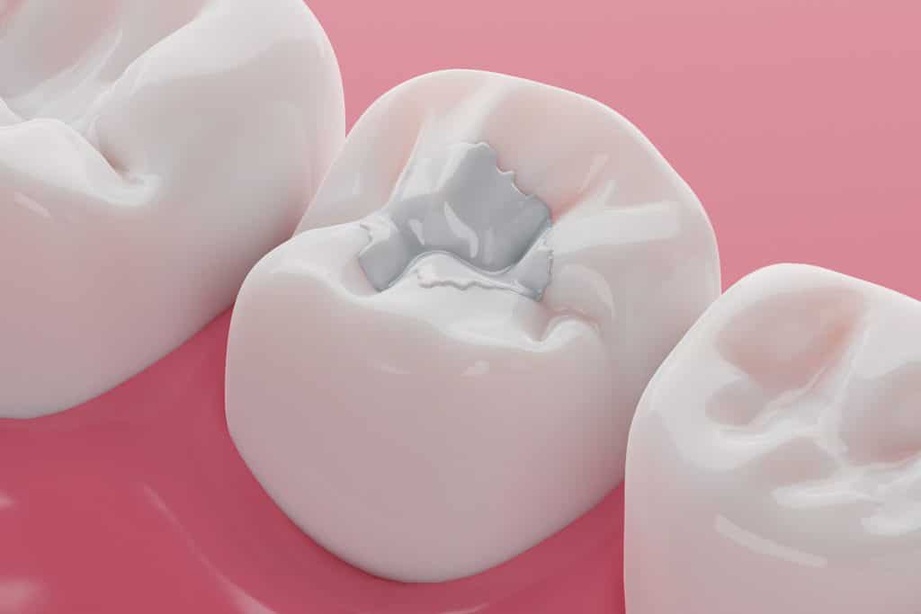 Inlays, Onlays, and Fillings: What's Best? - Oak Road Dentistry