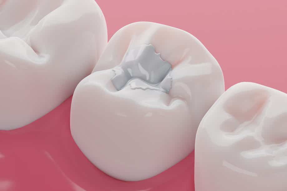What’s the Difference Between Inlays, Onlays, and Fillings?